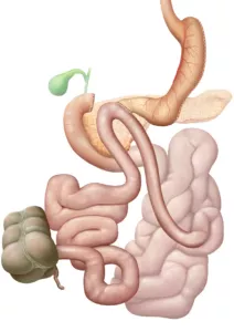 Darstellung Adipositaschirurgie: Biliopankreatische Diversion als Omega-Duodeno-ileostomie bei Adipositas, Single anastomosis duodeno-ileal bypass with sleeve gastrectomy (SADI-S). Der Effekt der Gewichtsreduktion beruht vor allem darauf, dass durch die Umstellung der Dünndarmlängen weniger Energieträger (Fette, Zucker, Proteine) durch die Nahrung in den Körper aufgenommen werden. Bei der Adipositas (Fettleibigkeit, Obesitas, Fettsucht) handelt es sich um eine Ernährungs- und Stoffwechselkrankheit mit starkem Übergewicht. Der Verdauungstrakt (Verdauungsapparat, Apparatus digestorius) umfasst die Organe die der Aufnahme, der Zerkleinerung und dem Weitertransport der Nahrung dienen, um diese letztlich zu verdauen und die darin enthaltenen Nährstoffe für den Körper verwertbar zu machen, zusammen. Als Verdauung (Digestion) bezeichnet man den Aufschluss der Nahrung im Verdauungstrakt mit Hilfe von Verdauungsenzymen.