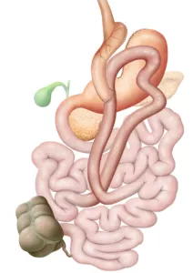 Darstellung Mini Gastric Bypass, MGB, Magenbypass Operation gegen Fettleibigkeit beim Menschen mit krankhafter Adipositas. Der Effekt der Gewichtsreduktion beruht vor allem darauf, dass durch die Umstellung der Dünndarmlängen weniger Energieträger (Fette, Zucker, Proteine) durch die Nahrung in den Körper aufgenommen werden. Bei der Adipositas (Fettleibigkeit, Obesitas, Fettsucht) handelt es sich um eine Ernährungs- und Stoffwechselkrankheit mit starkem Übergewicht. Der Verdauungstrakt (Verdauungsapparat, Apparatus digestorius) umfasst die Organe die der Aufnahme, der Zerkleinerung und dem Weitertransport der Nahrung dienen, um diese letztlich zu verdauen und die darin enthaltenen Nährstoffe für den Körper verwertbar zu machen, zusammen. Als Verdauung (Digestion) bezeichnet man den Aufschluss der Nahrung im Verdauungstrakt mit Hilfe von Verdauungsenzymen.